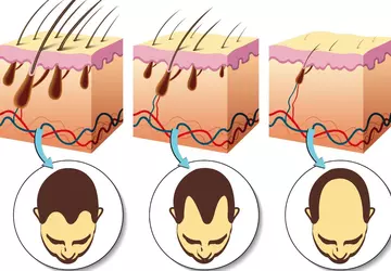 Plaster z mikroigłami pokonuje łysienie poprzez ...