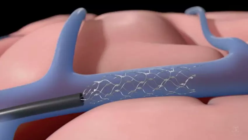 Konkurent Neuralink uzyskał zgodę na badania na ludziach