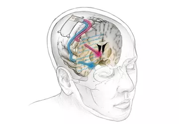 Pierwszy na świecie implant mózgu skutecznie ...